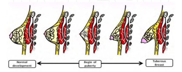 tuberous breasts London Plastic Surgery New Zealand