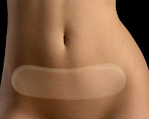 silicone strips London Plastic Surgery