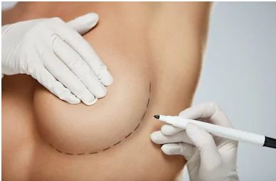 breast augmentation