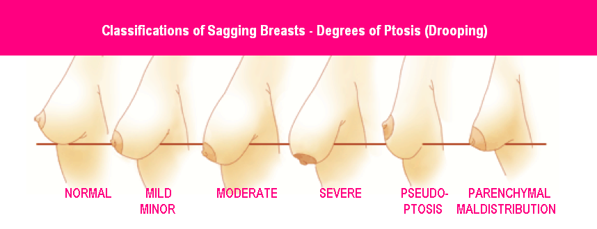 Saggy and Droopy Breast Chart London Plastic Surgery