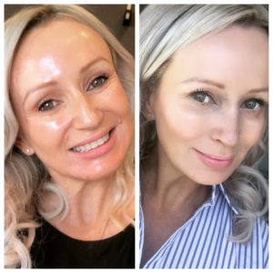 Nose Surgery Rhinoplasty Before and After Photos
