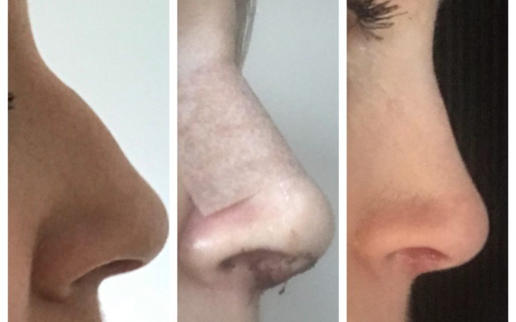 Rhinoplasty Before and After Photos Mark Gittos Plastic Surgeon Specialist UK