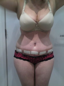 Mummy Makeover - Tummy Tuck Before and After Photos