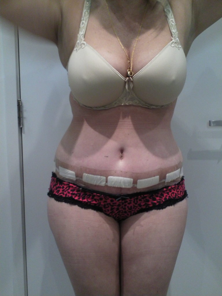 Tummy Tuck Before and After Photos London Plastic Surgery