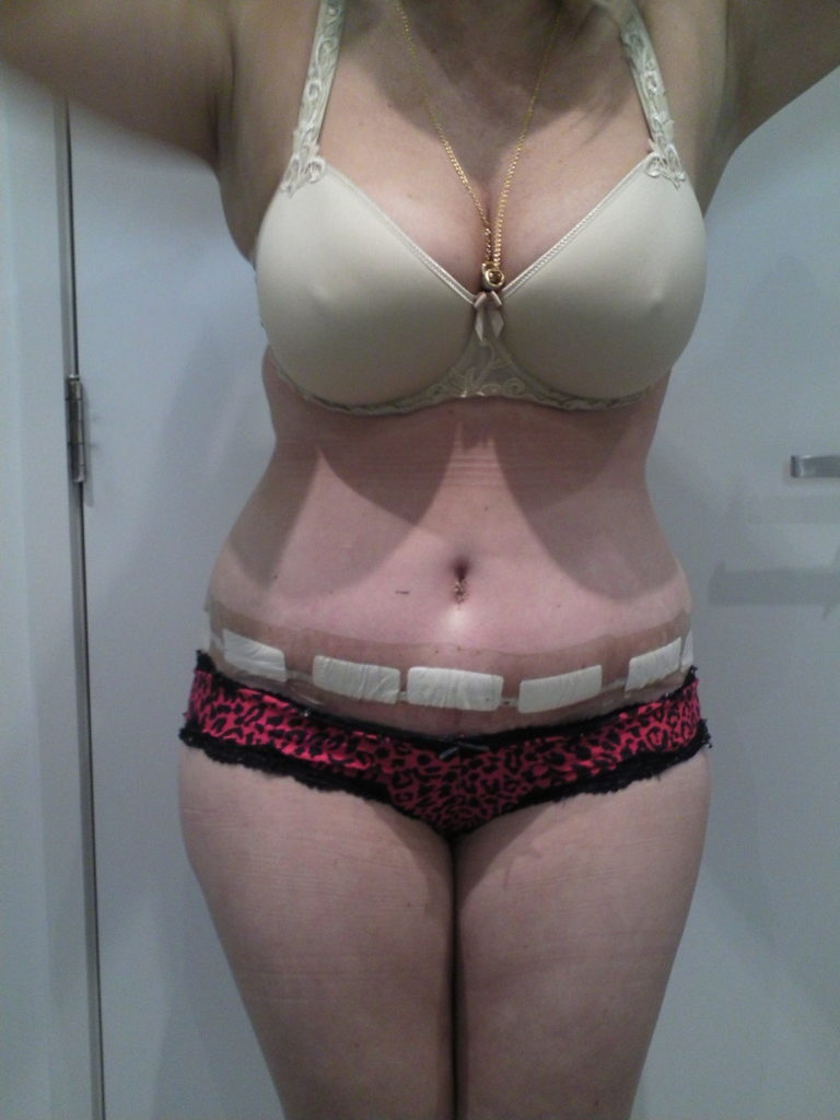 Tummy Tuck Before and After Photos Mr Mark Gittos Plastic Surgeon Specialist Uk