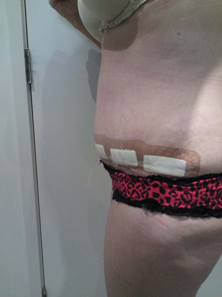 Tummy Tuck Before and After Photos Sideview Mark Gittos
