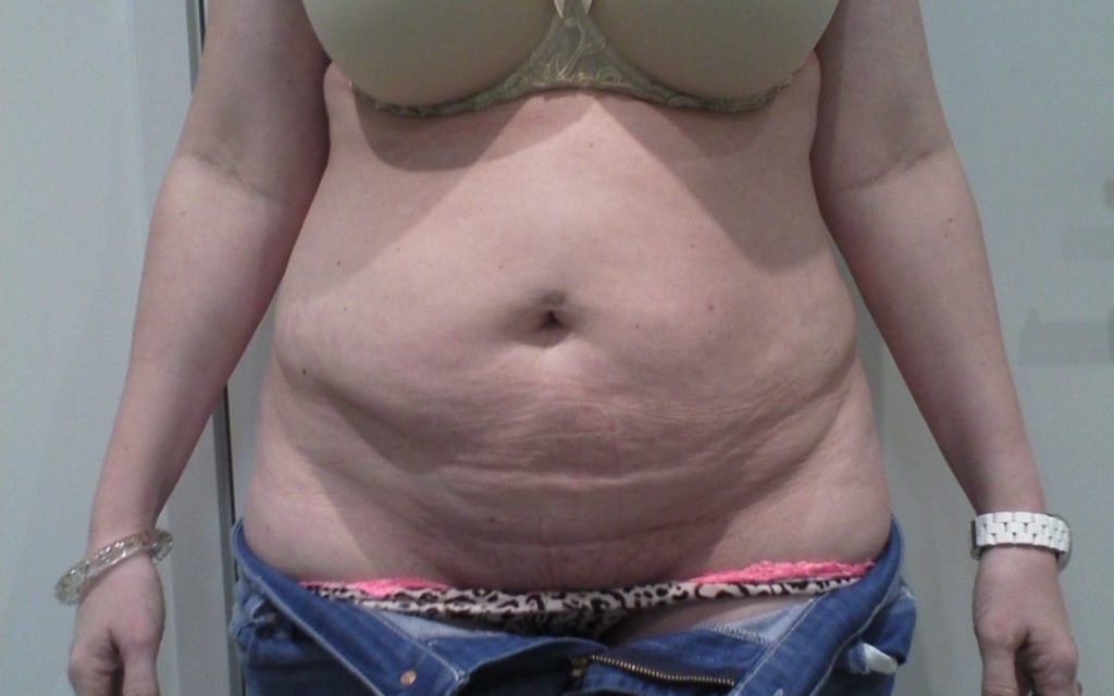 Tummy Tuck Before and After Photos UK Mark Gittos