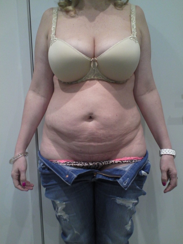 Tummy Tuck Before and After Photos Mark Gittos London Plastic Surgery