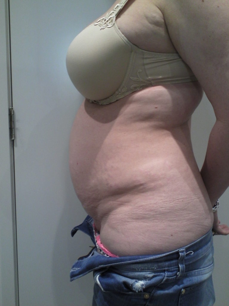 Tummy Tuck Before and After Photos Mark Gittos London UK