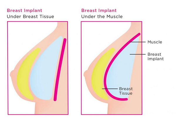 Breast Implant Placement Under Muscle Mr Mark Gittos Best Breast Surgeon UK