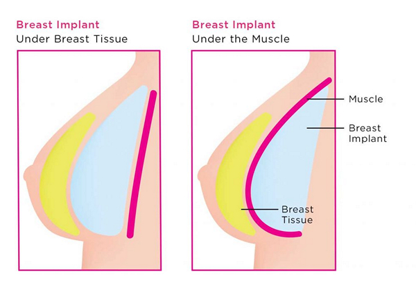 What's the Best Type of Breast Implants & Other Top Breast