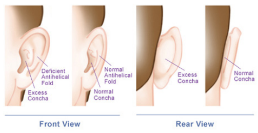 otoplasty ear surgery best ear plastic surgeon UK for kids