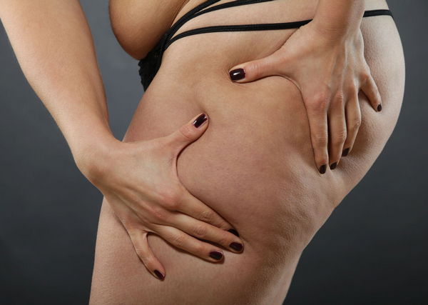 liposuction nz