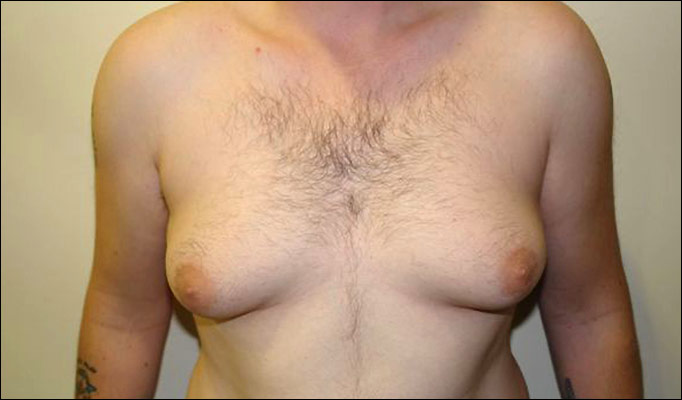 Male Breast Reduction Mr Mark Gittos Best Breast Surgeon UK