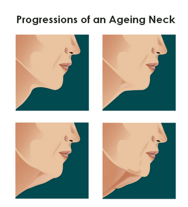 Neck Surgery Saggy Neck Droopy neck Best Necklift Surgeon UK