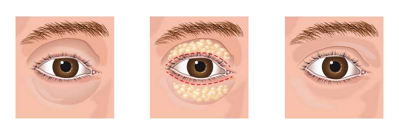 eyelid surgery mistakes London Plastic Surgery