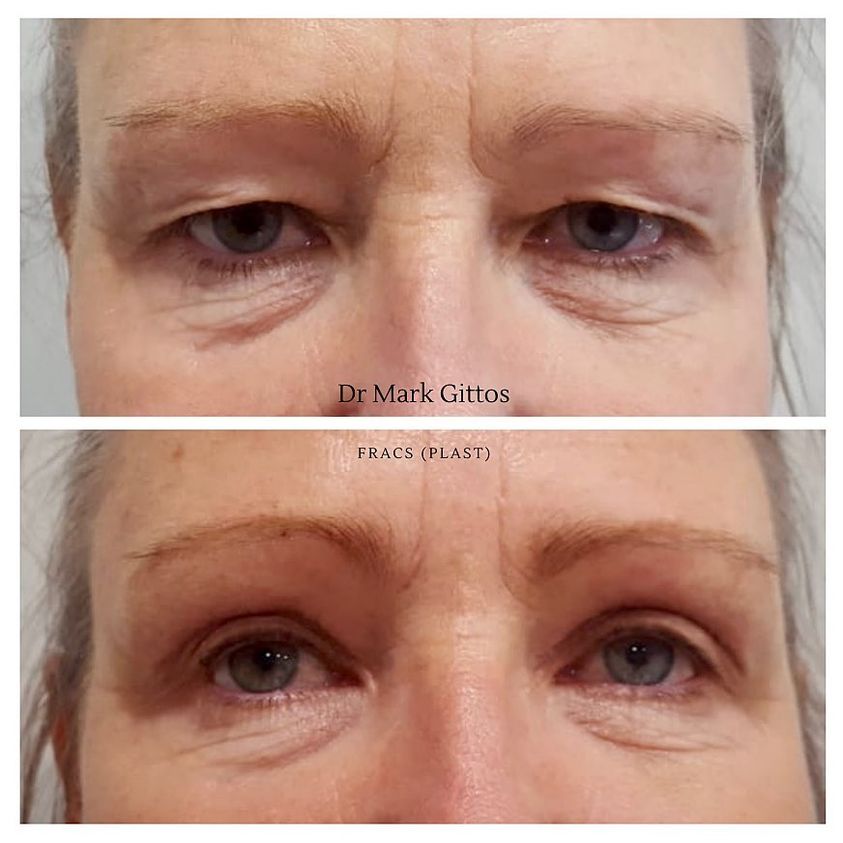 Eyelid Lift Before and After by Mr Mark Gittos UK Plastic Surgeon 