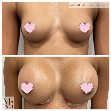 Breast Augmentation with Motiva Implants Mark Gittos Plastic Surgeon Specialist Uk