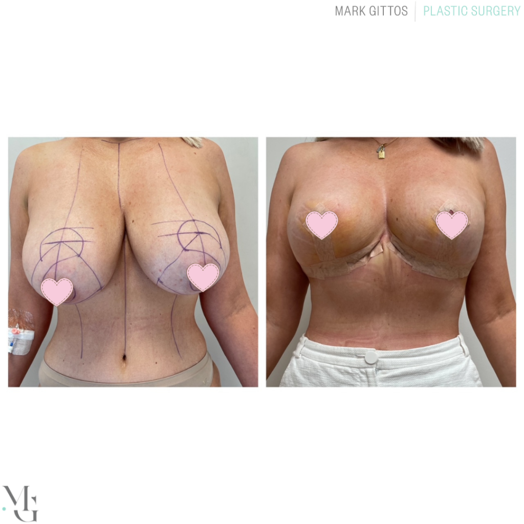 Breast reduction before and after Photos Mr Mark Gittos UK