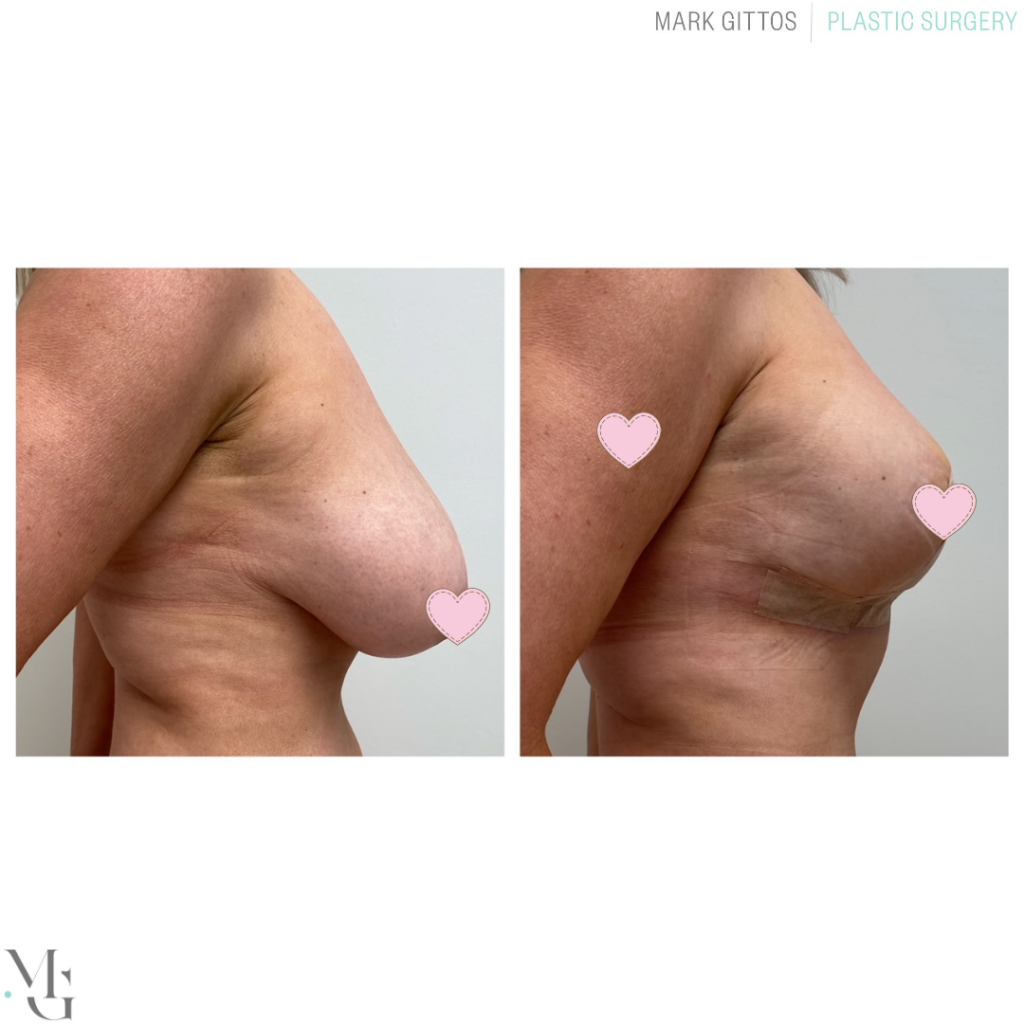 Breast reduction photos - Boob Reduction pics Mark Gittos Best Breast Surgeon UK