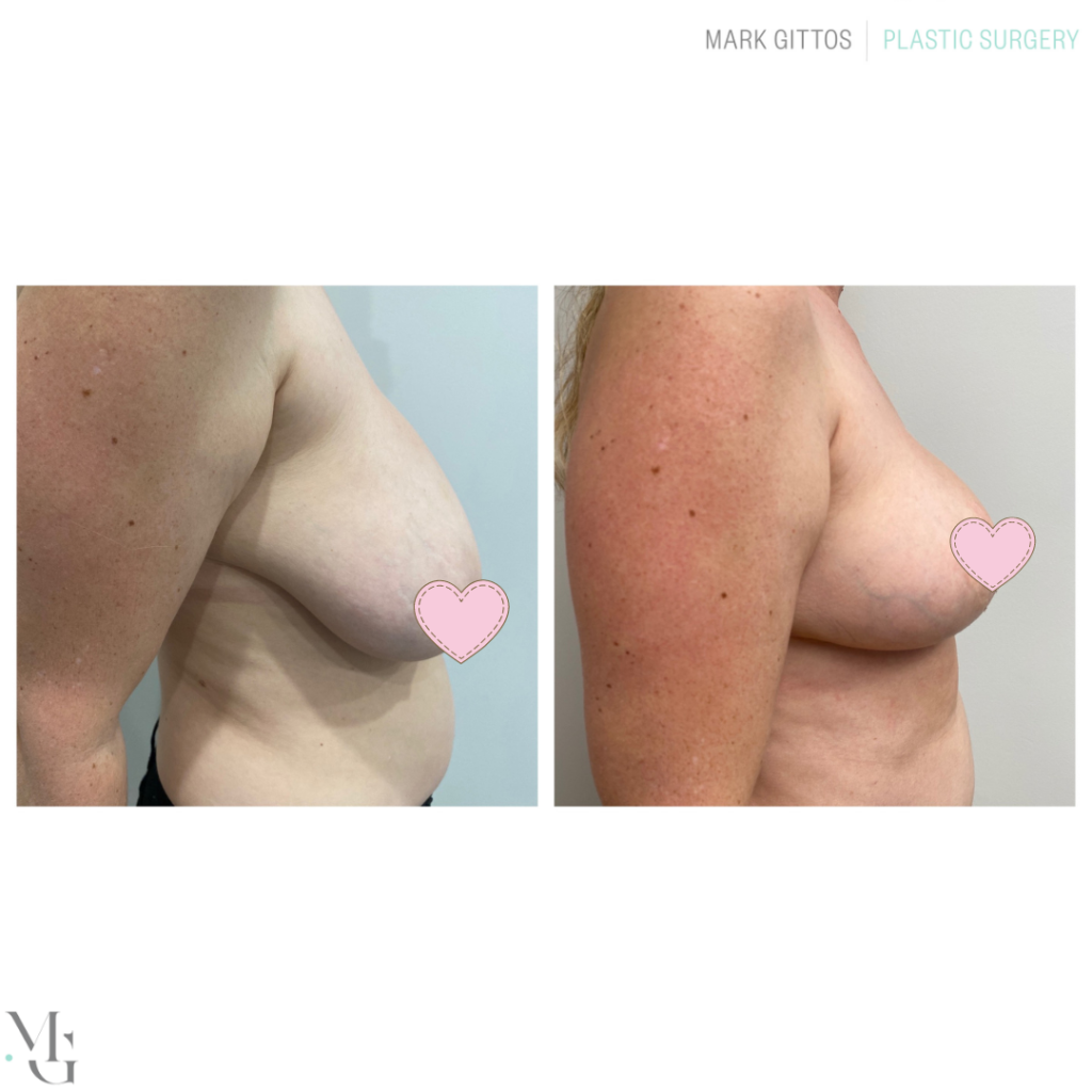 Boob reduction pics Before and After Breast Reduction