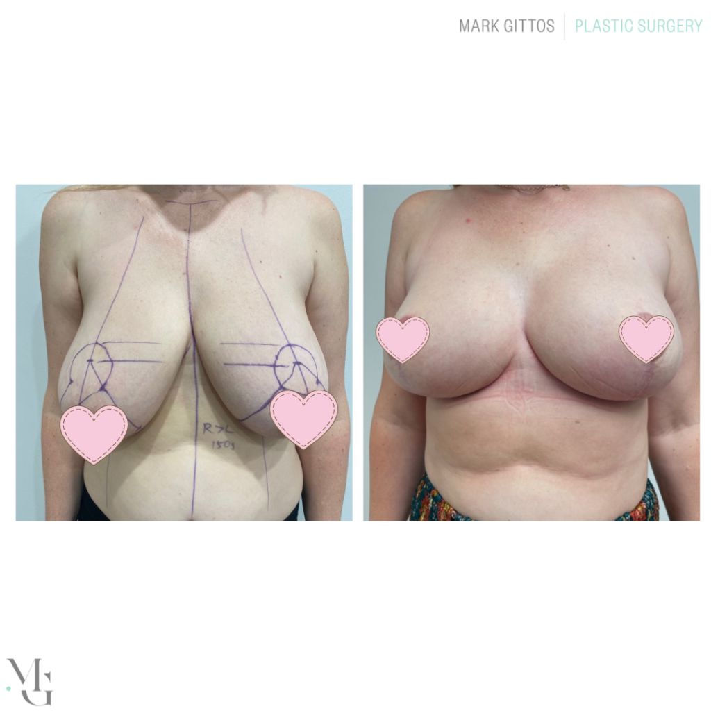 Breast reduction Before and After Boob Reduction Mr Mark Gittos Best Breast Surgeon UK