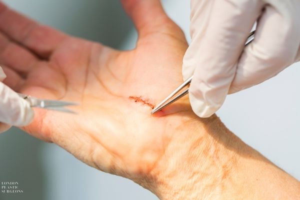Carpal-Tunnel-Procedure_Mr-Mark-Gittos_Best-Plastic-Surgeon_UK