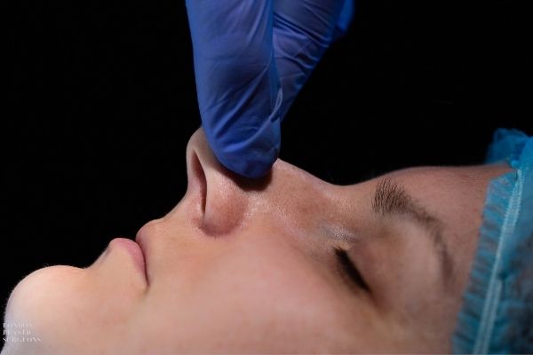 Tip Rhinoplasty Procedure Mr Mark Gittos Plastic Surgeon Specialist UK