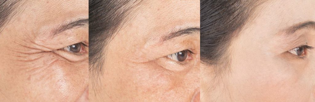 How to get rid of under eye wrinkles?