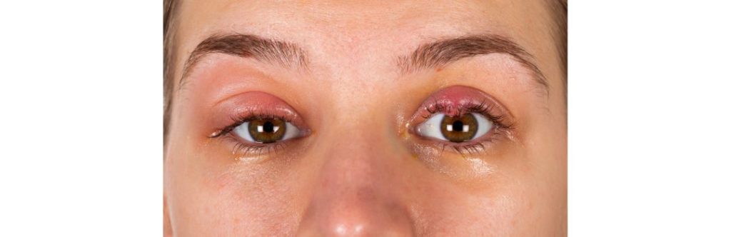 Lump After Blepharoplasty